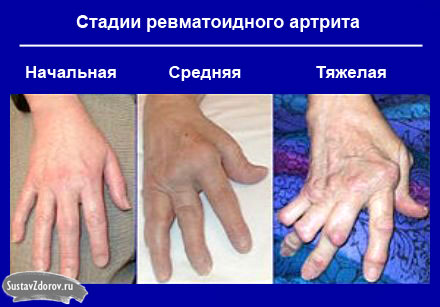 reumatoidinis artritas šepetys ranka gydymas