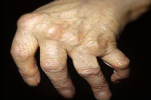 artritas rankų moterims