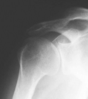 skandinavijos walking artrozės peties sąnario osteomielitas alkūnės sąnario gydymas