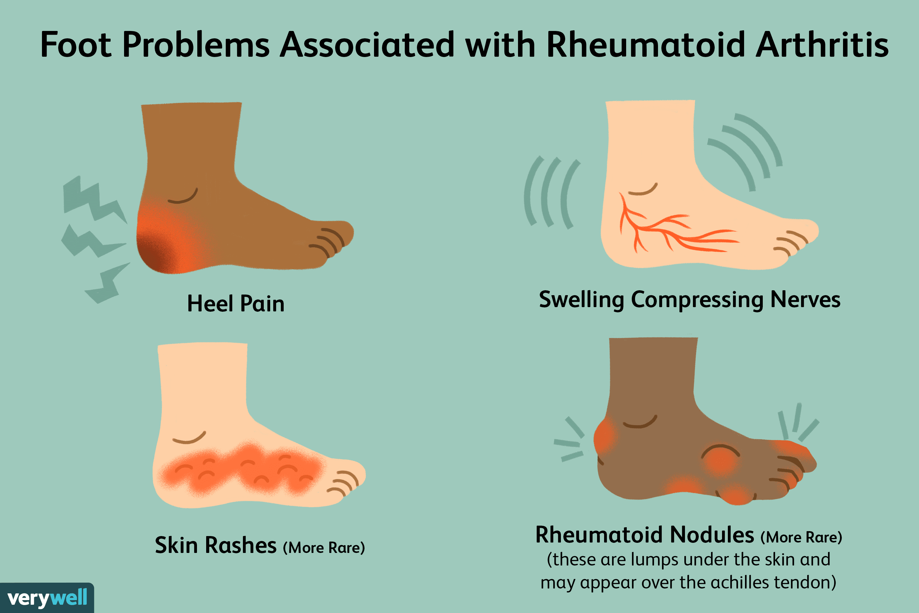 swollen painful joints in feet