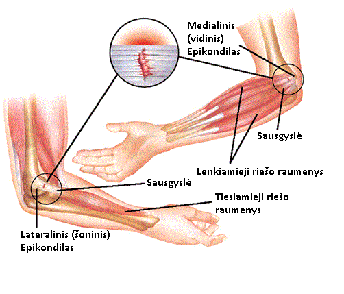 sąnario artrozė