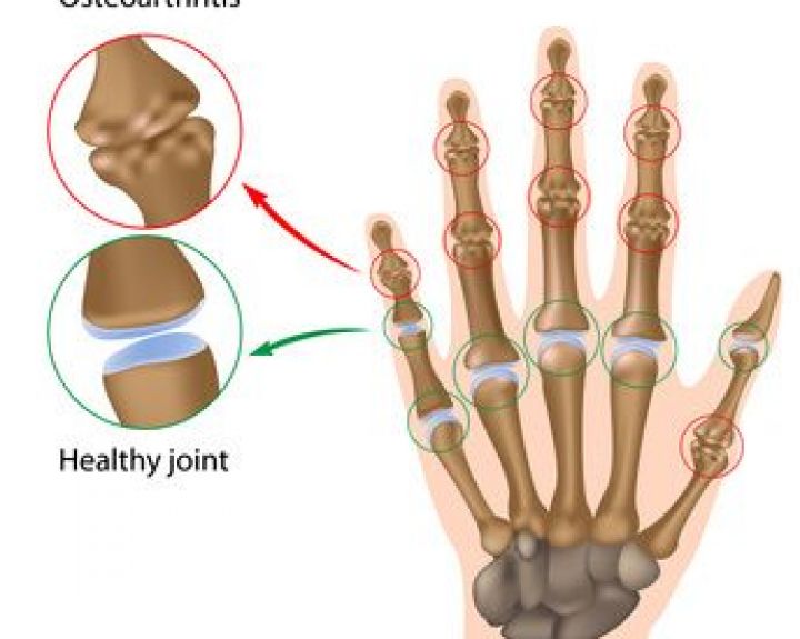 gydymo artritas artrozė apžvalgų