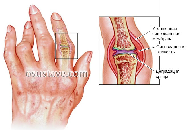 liaudies būdų gydyti artritą rankas