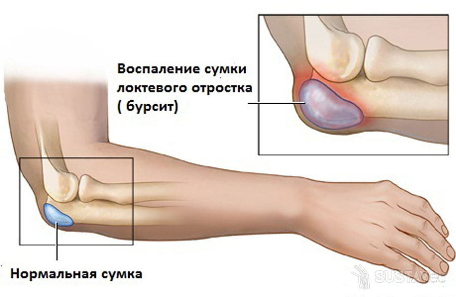 bursith alkūnės sąnario sukelia gydymas lėtinis artritas rankų