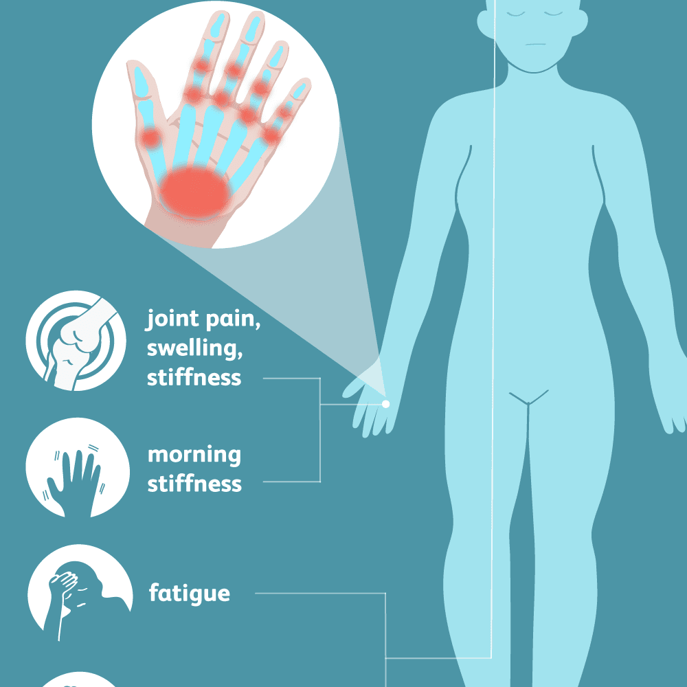 swelling your joints gydymas osteoartrozės pėdos sąnarių liaudies gynimo priemones