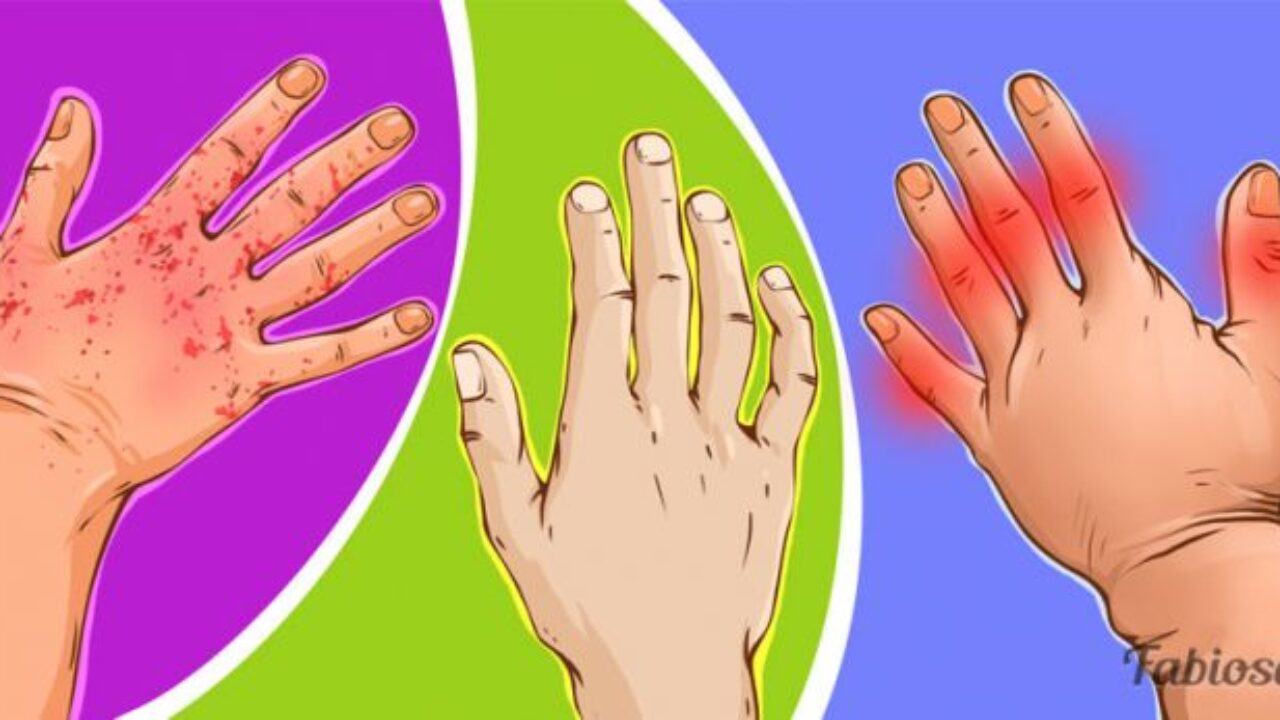 kaip įspėti artritas pirštų rankas gydymas sąnarių skausmas tradiciniais metodais