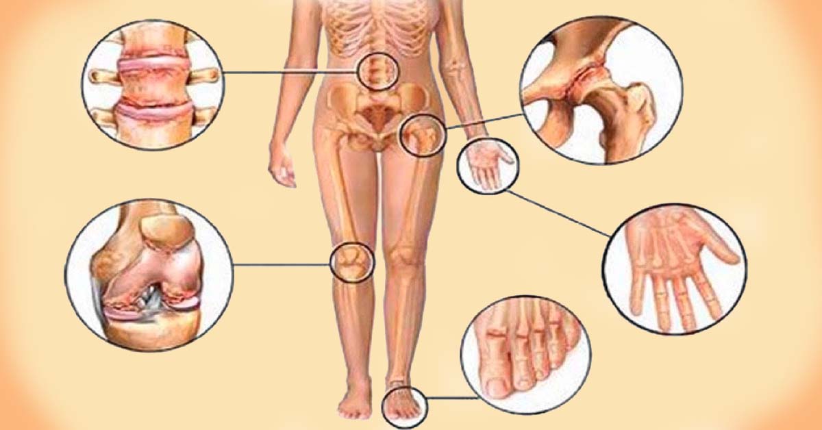 kad kenkia sąnariams 6 priežastys artrozės