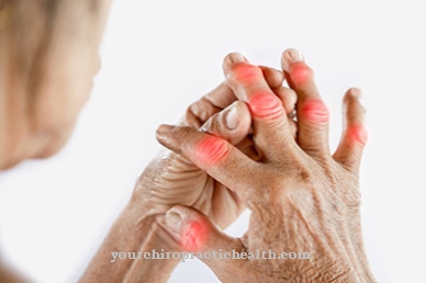 artritas prieš artrozės gydymo fone eos dėl sąnarių atsiliepimai kaina gydymo