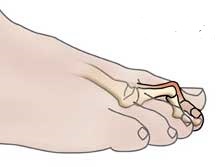artritas iš piršto pėdos