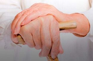 gydymas artrito namie ant rankų pirštų skausmas artrozės sąnarių