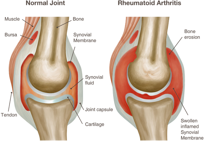 reumatoidinis artritas simptomai