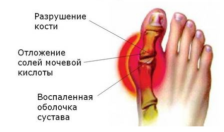 artrozė teptukas rankų valymo