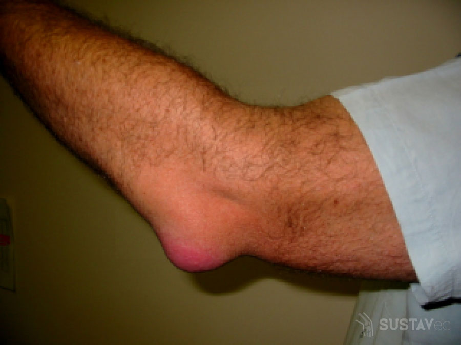 bursith alkūnės sąnario sukelia gydymas skausmas ir aštrus sąnarių