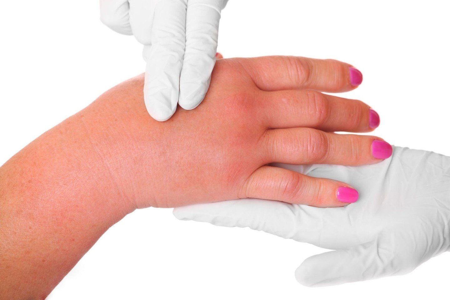 kaip pašalinti patinimas ranka artritas