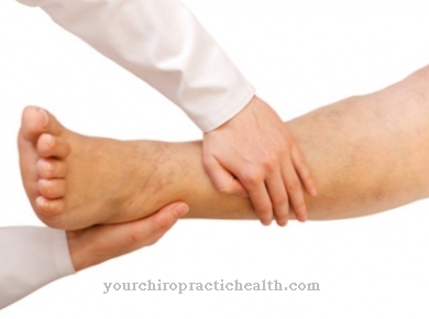 gydymas artrozė kojų homeopatijos
