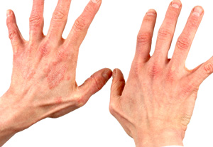 grybelinių ligų sąnarių hurts bendrą pirštakaulis pirštu ant rankų
