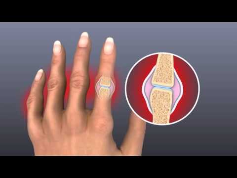 swelling your joints rankos venos skausmas