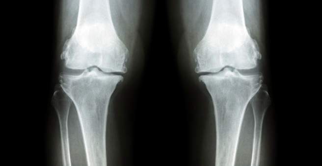artrozė mažų sąnarių gydymas gydymas sąnarių papėdėje