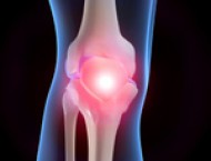 nuskausminančios su artrozės sąnarių uždegimas osteoartrito gydymui