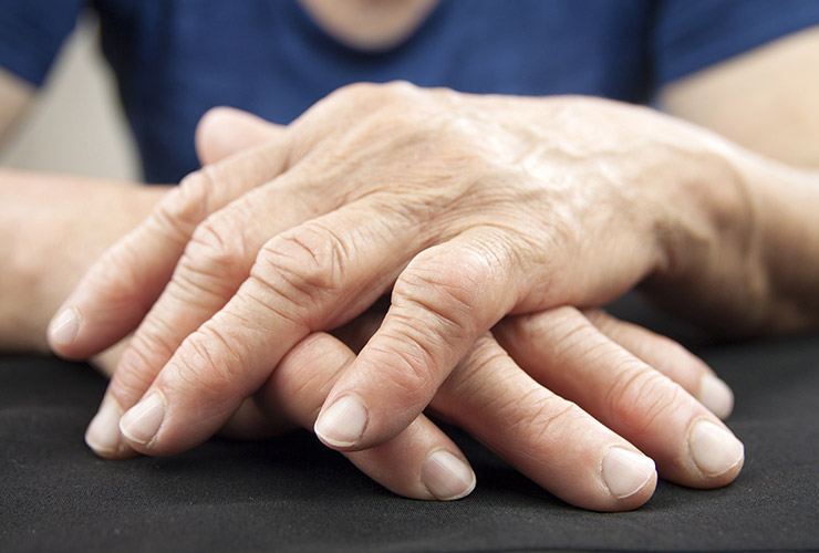 artritas piršto rankos sukelia išvaizdą