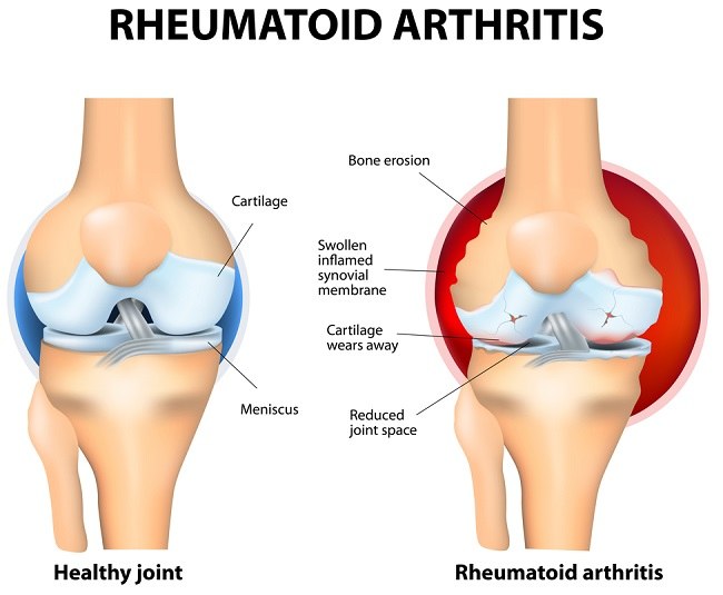 reumatoidinis artritas
