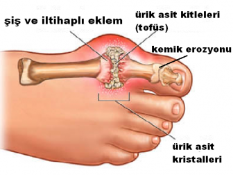 prevencija artritu sąnarių ant rankų