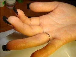 tepalas nuo artrito sąnarių pavadinimas gydymas artrozės šepečiai rankas