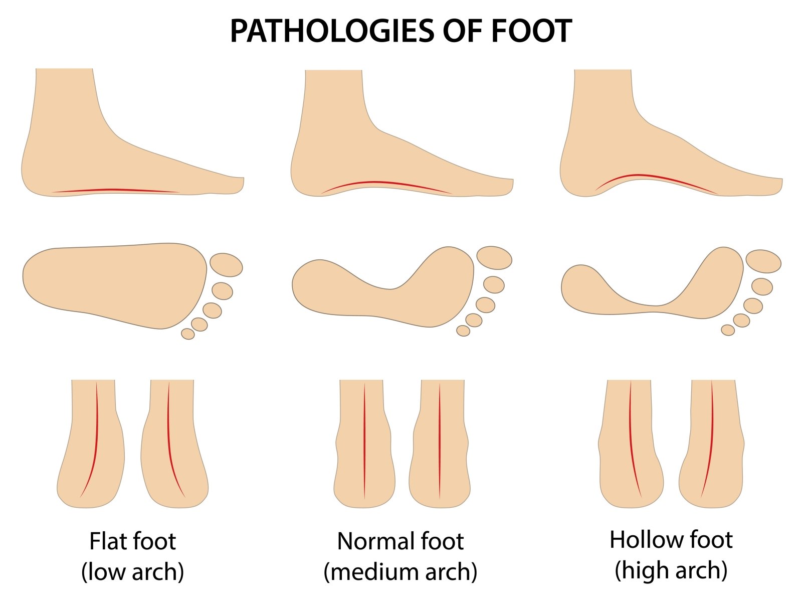 artrozė pėdos plokščiu maisto gydymas namuose laukiniai skausmas sąnarių