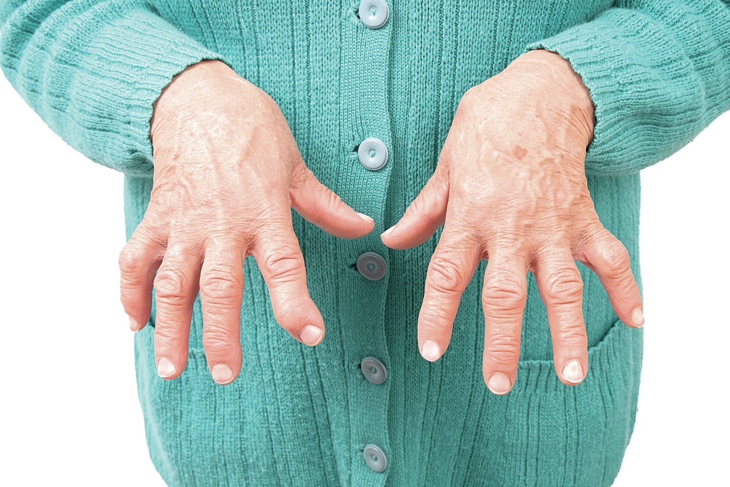 artritas arba sąnarių uždegimas