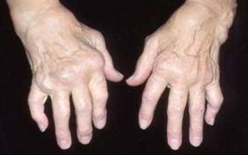 artrozė artritas bendrus žandikaulių