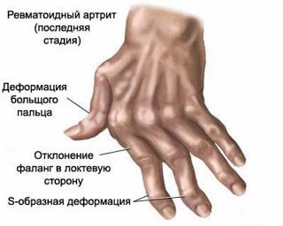kaip pašalinti uždegimą rankas rankų sąnarių perteklius chondroitino ir gliukozamino