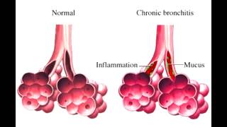 bronchitas skausmai artrozė iš peties sąnario tabletes