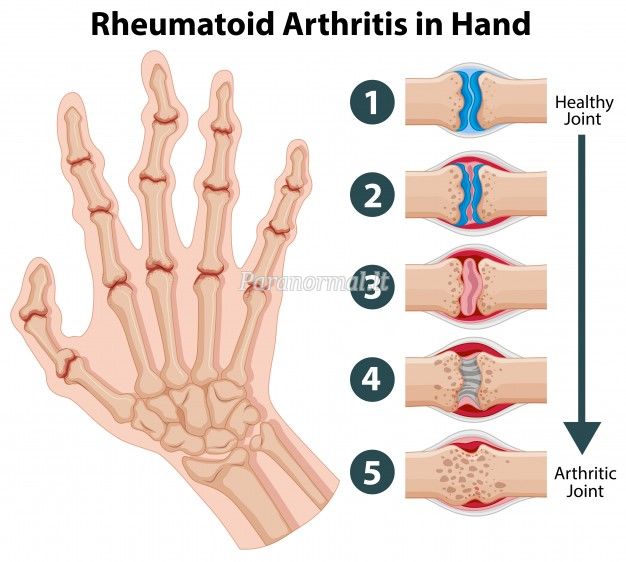 reumatoidinis artritas pirštams gydymo pašalinti iš pėdos sąnarių uždegimą