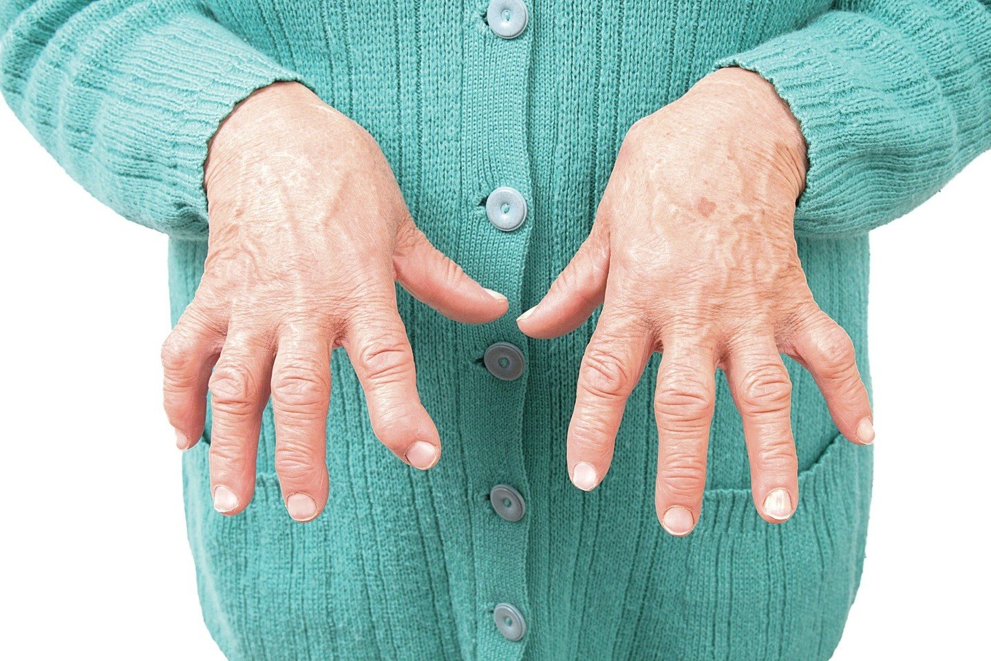 artritas artritas pirštai