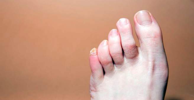 artritas pirštų pėdų gydymas