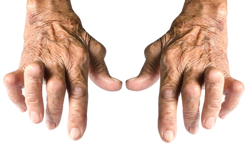 artritas piršto rankos gydymas mazi sąnarių gydymo
