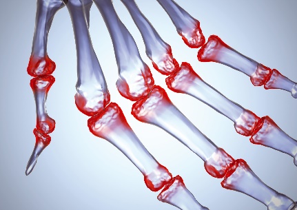 artritas sąnarių sustabdyti 3 etapai vyrai sąnarių skausmas