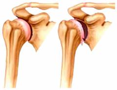 duriantis skausmas nugaros apacioje nurofen artritas sustava
