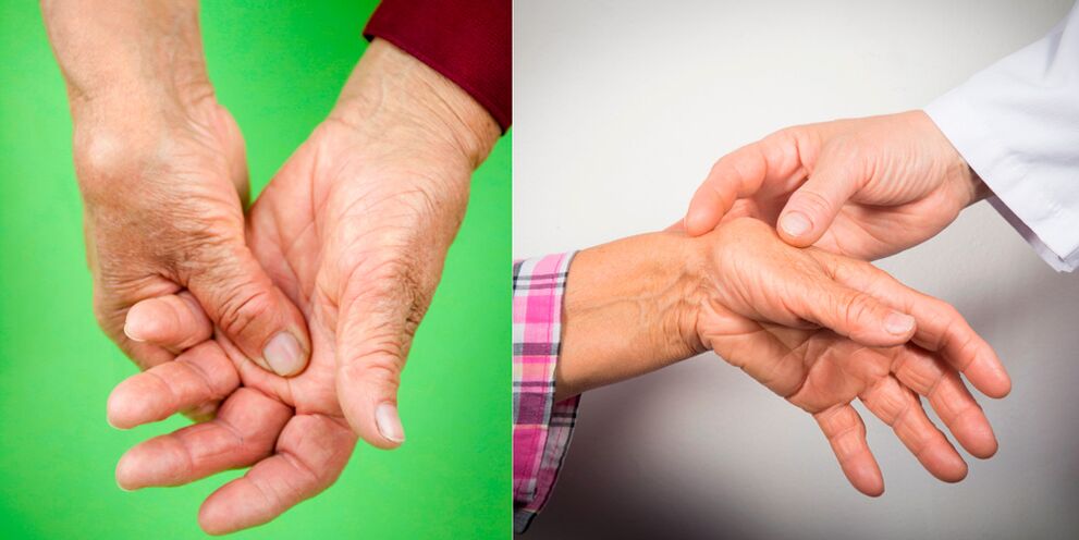 artrozė iš rankų riešo gydymo liaudies gynimo spondylosis artrozė gydymas