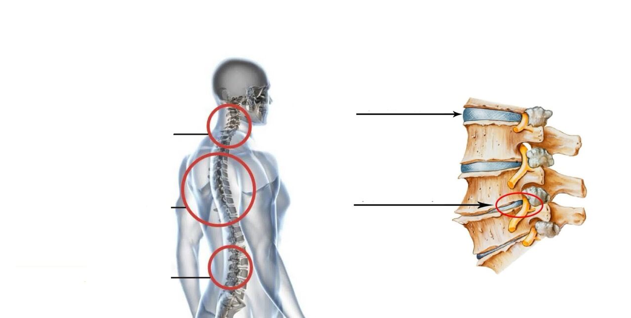 gydymas potrauminio artrozės peties sąnario skauda visus sąnarius ir raumenis kad ji
