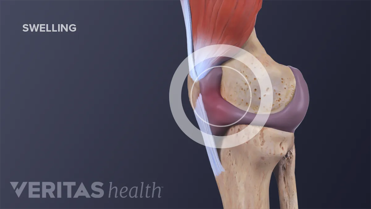 swelling your joints pėdos sąnario ir kulno skausmas