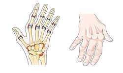 reumatoidinis artritas