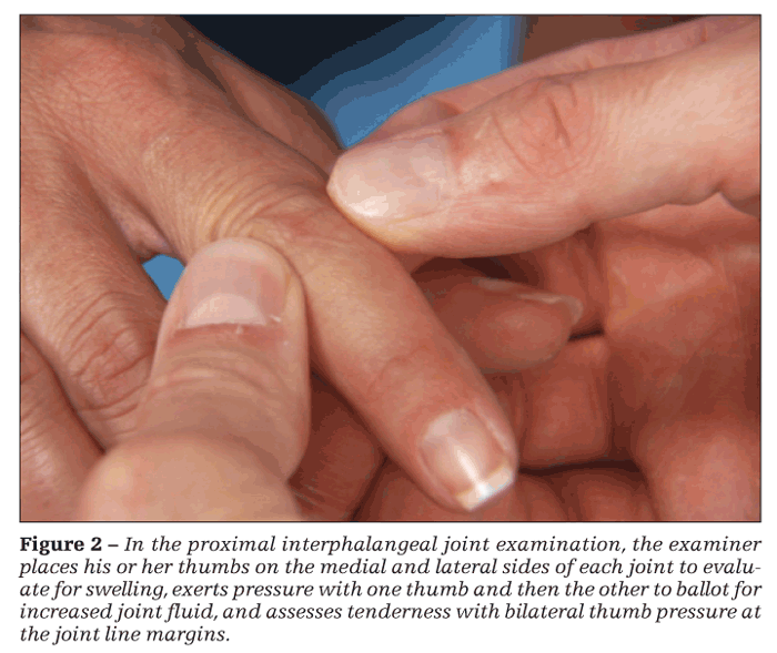 swelling in joints of one hand saldainiai sąnarių ant pirštų