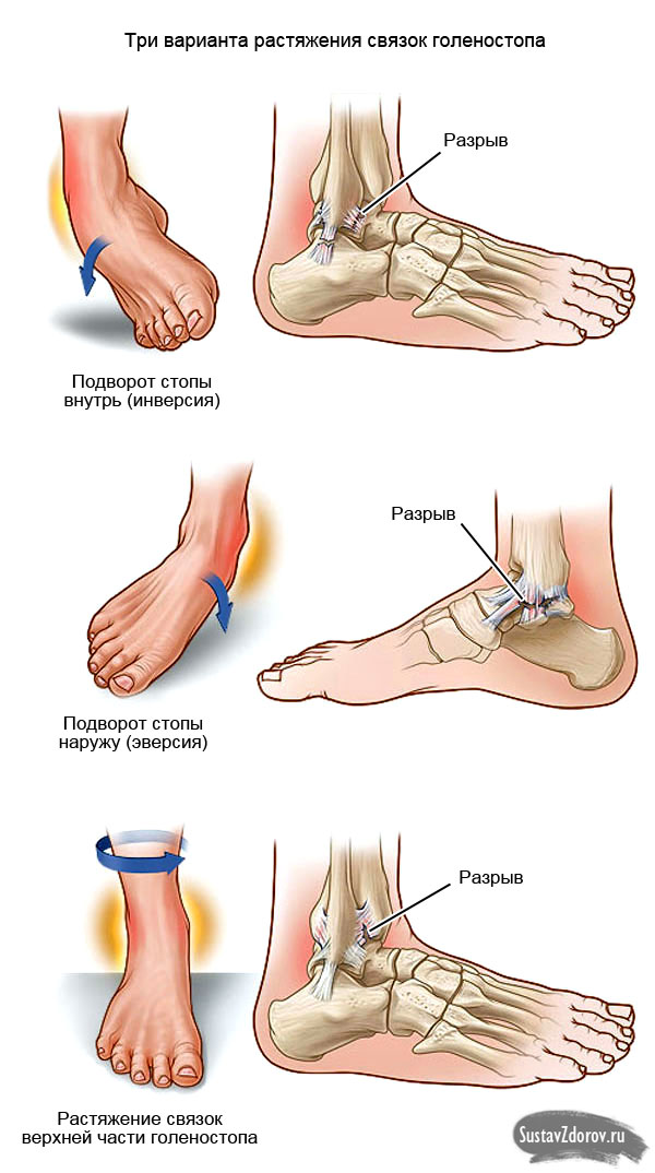 jungtinis ant pėdų gydymui ką daryti su artritu pirštų