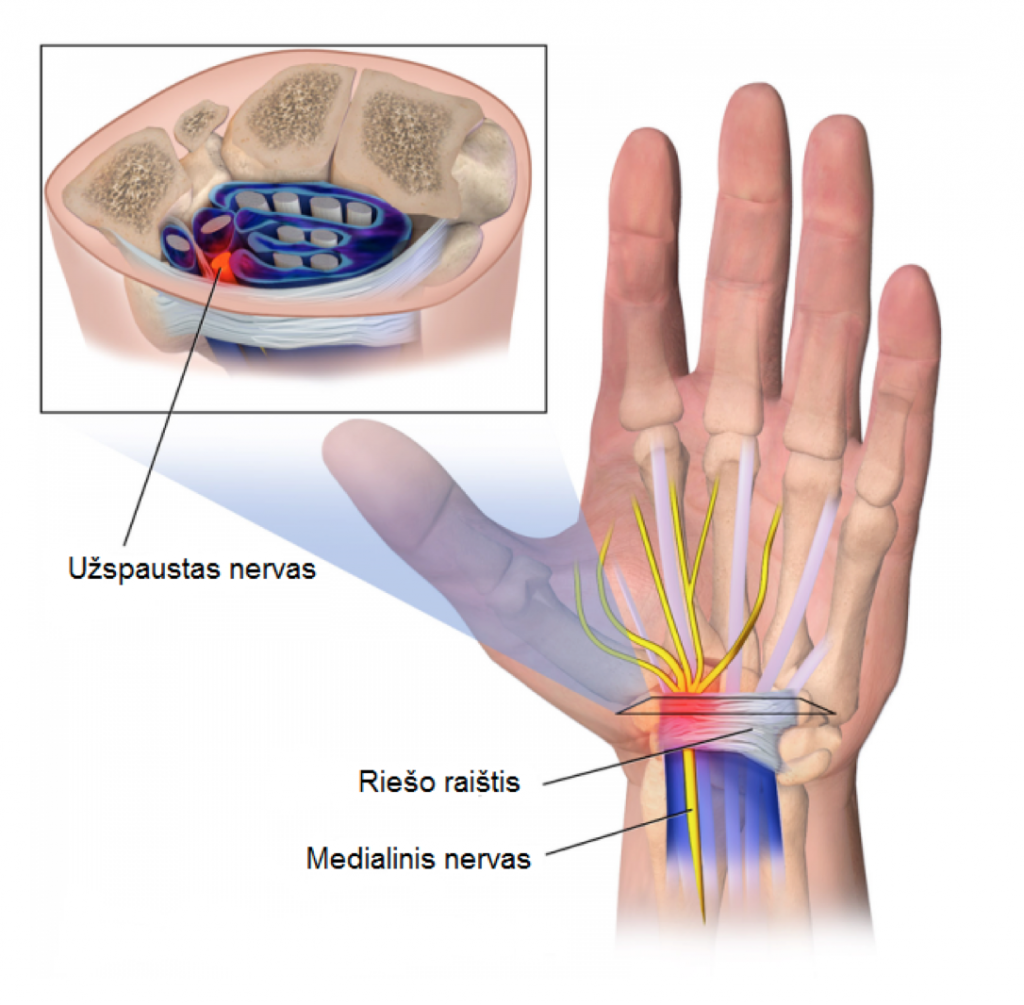 artrozė ir artritas rankos