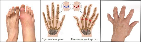 gydymo brush rankų nuo artrito