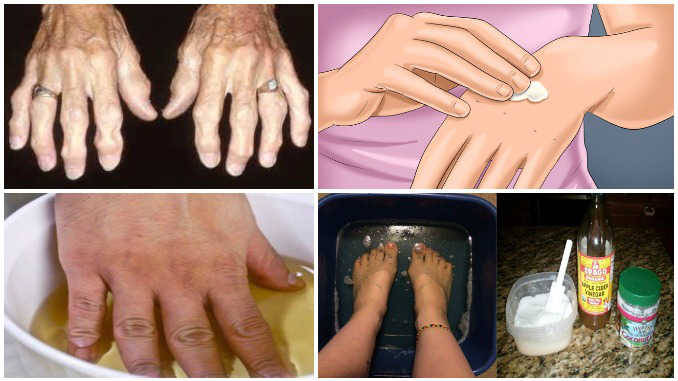 liaudies apdorojimo metodai sąnarių swollen painful joint in finger