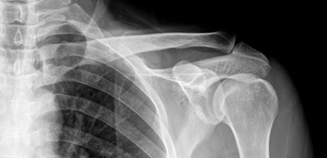 osteoartritas peties sąnario 2 laipsnių gydymas gydymas medicina sąnarių
