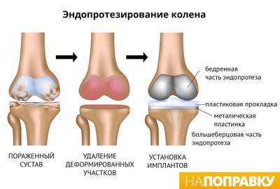 gydymo metodai artrozės 3 laipsnių artritas iš veido bendros prevencijos