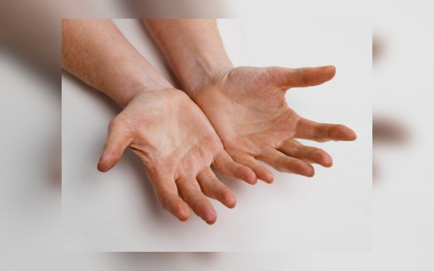 reumatoidinis artritas sąnarių žandikaulių